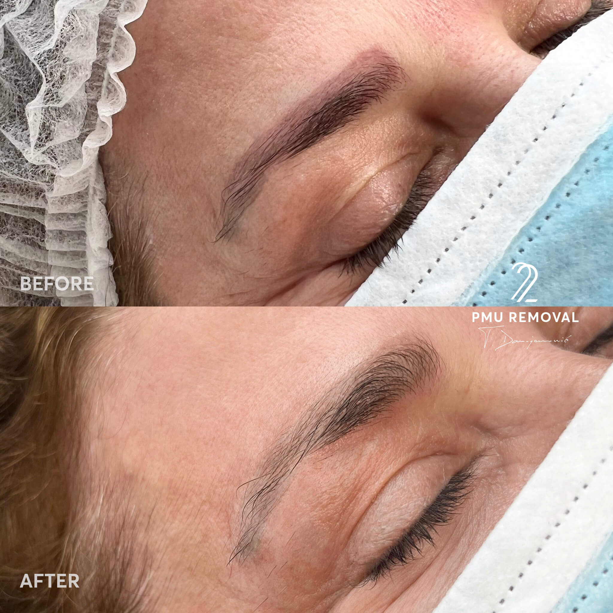 PMU Removal Gift Voucher